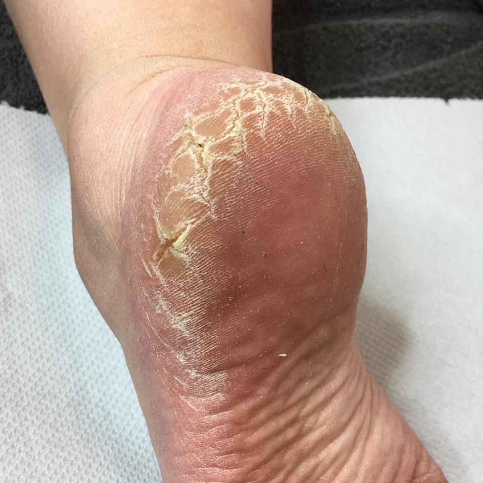 Dry, Cracked Feet 