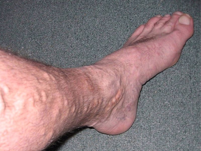 varicose veins on legs