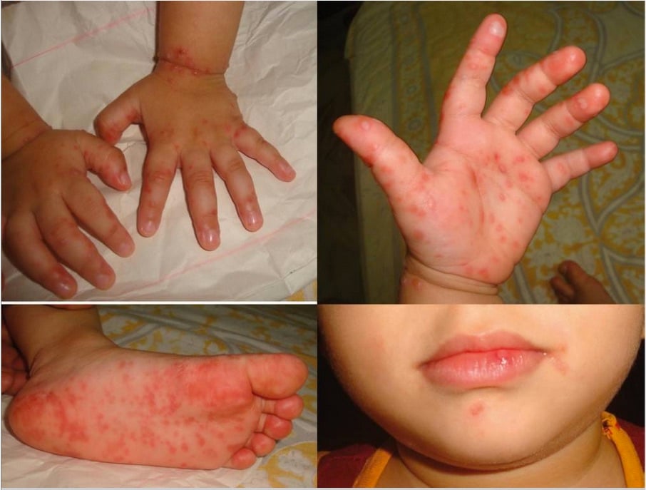 Hand, foot, and mouth disease PSA