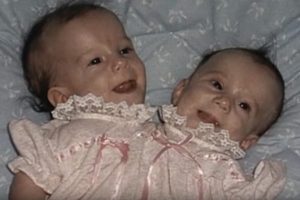 Conjoined Twins Abby And Brittany Hensel Are Now Thriving 30 Years Later