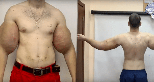 real-life popeye has 3 lbs of dead muscle removed from biceps