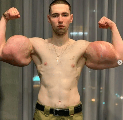 real-life popeye has 3 lbs of dead muscle removed from biceps