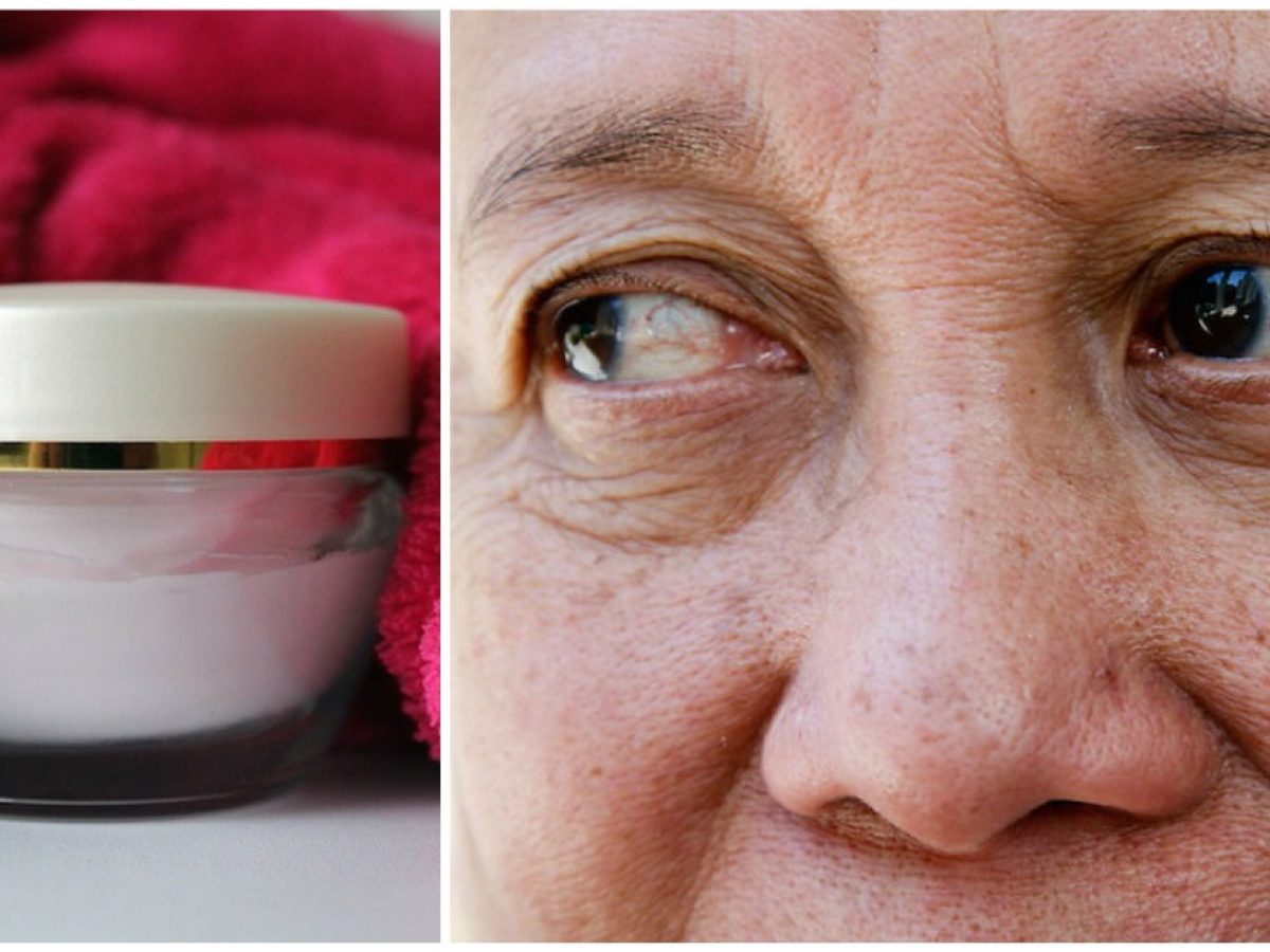 under eye wrinkles dermatologist