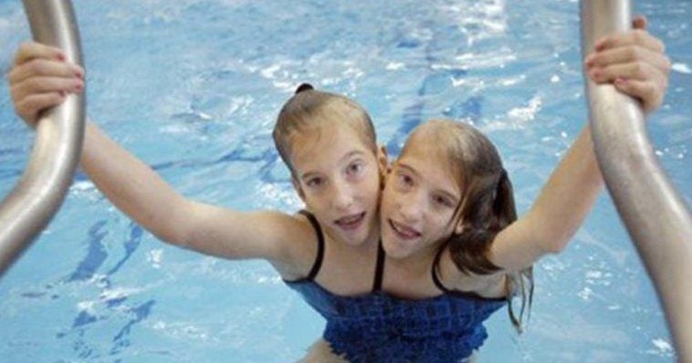 21 Years After We Met Conjoined Twins Abby And Brittany They Are All Grown Up Doyouremember