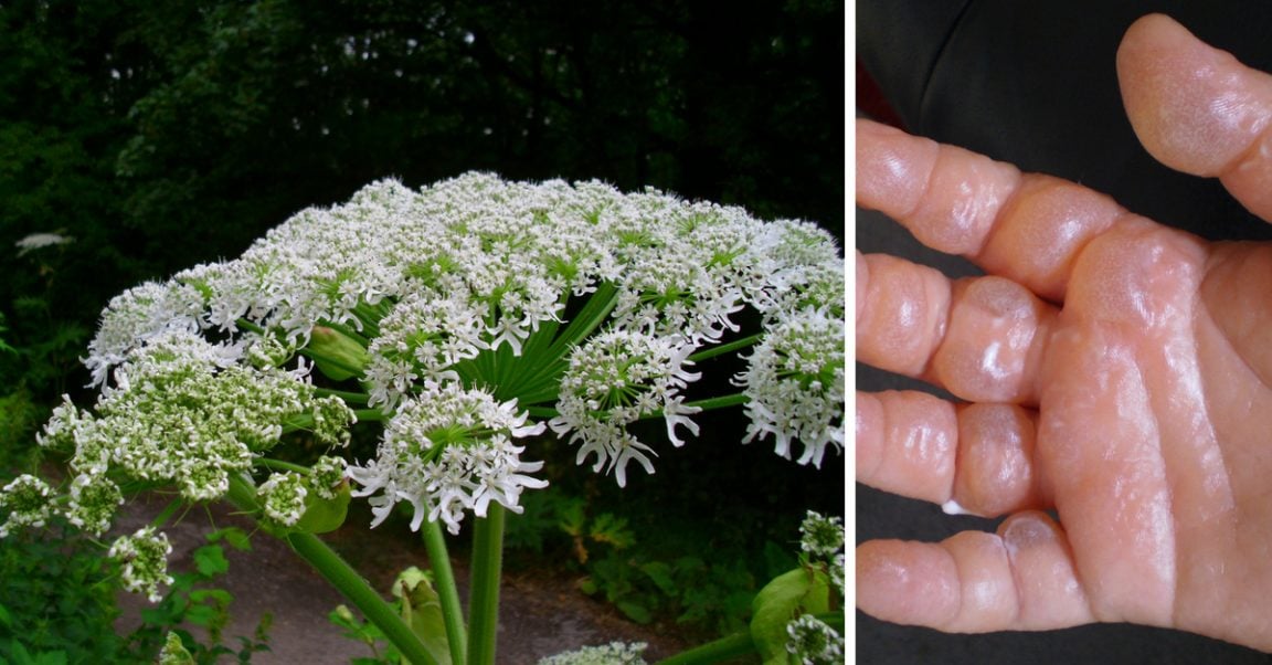 How To Avoid Severe Burns And Blisters From The Giant Hogweed Plant