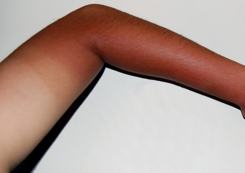 burned skin after sun exposure