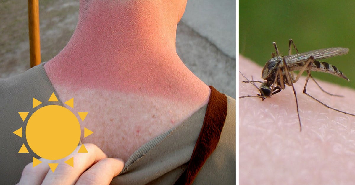 The Best Ways To Treat Sunburns, Bug Bites, Heat Stroke And Other Summer Ailments