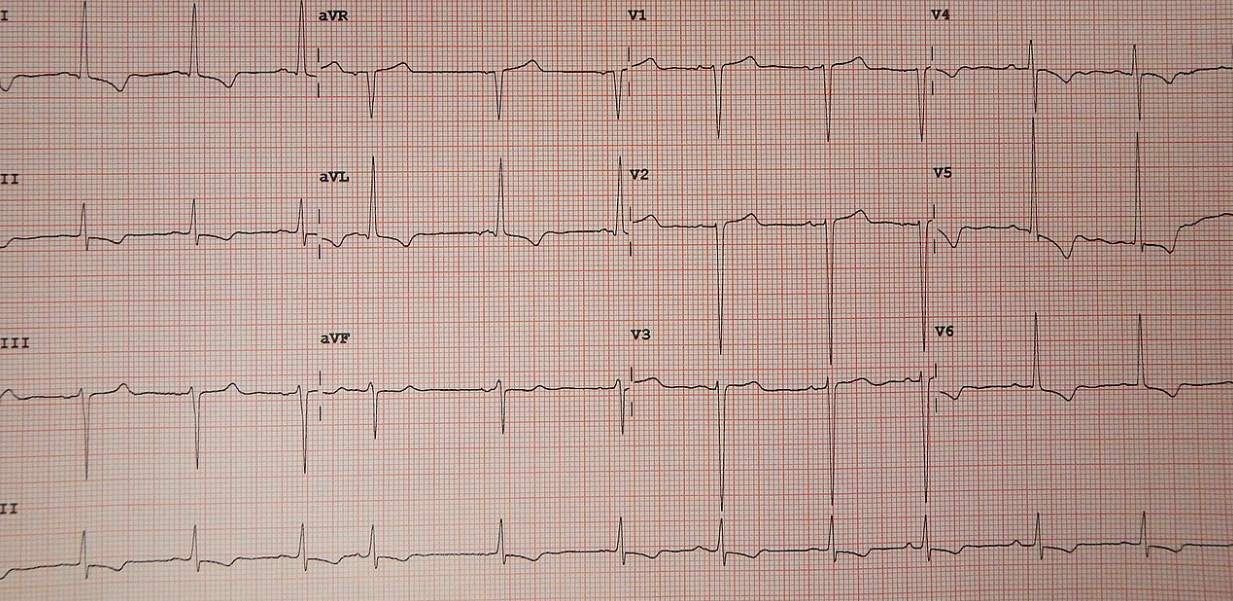 ekg