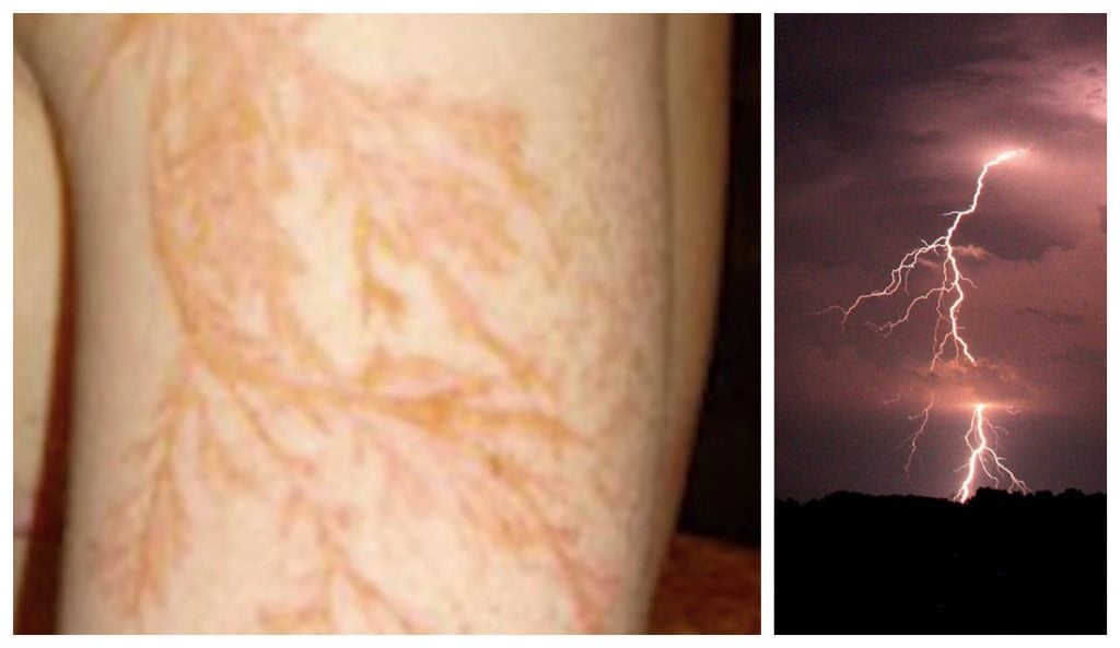 do lightning strike humans