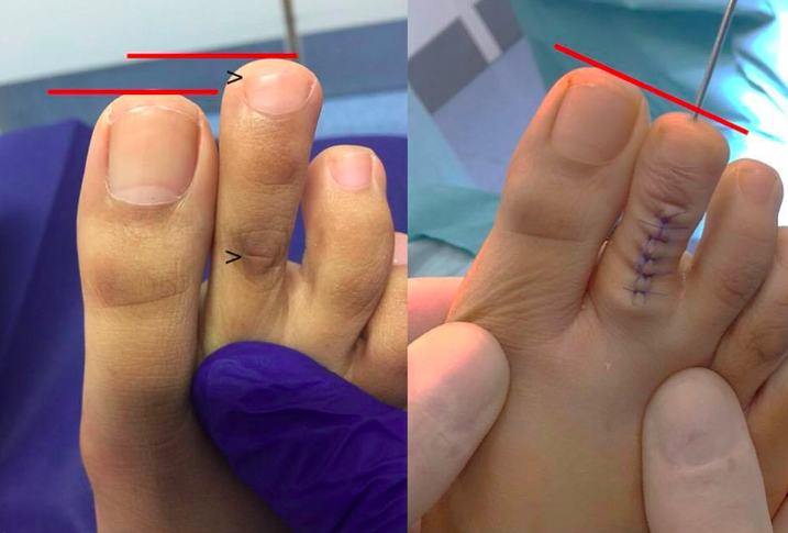 toe-shortening-surgery-is-a-real-thing-and-more-common-than-you-d-think