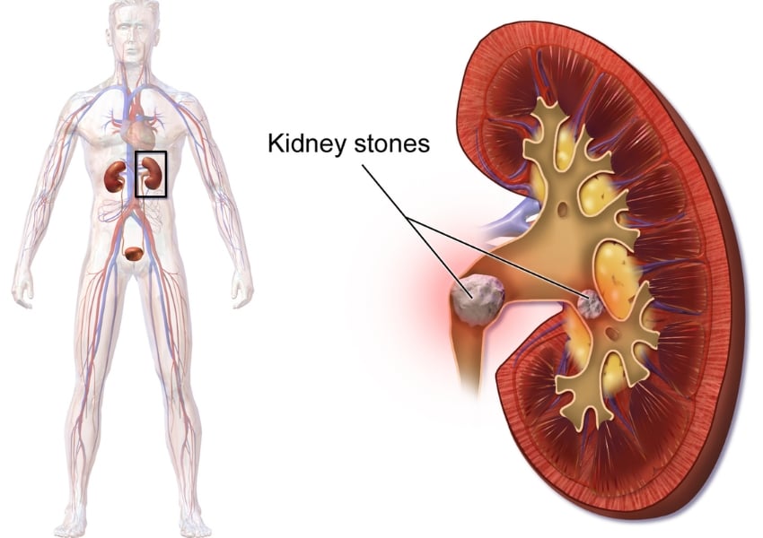 kidney stone