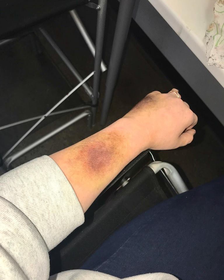 bruise