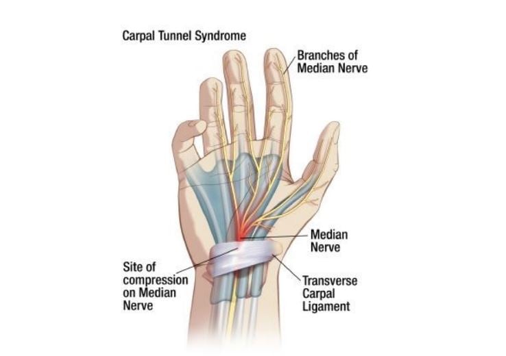 carpal tunnel