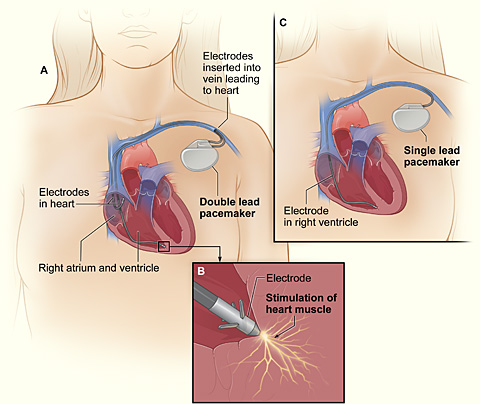 pacemaker info