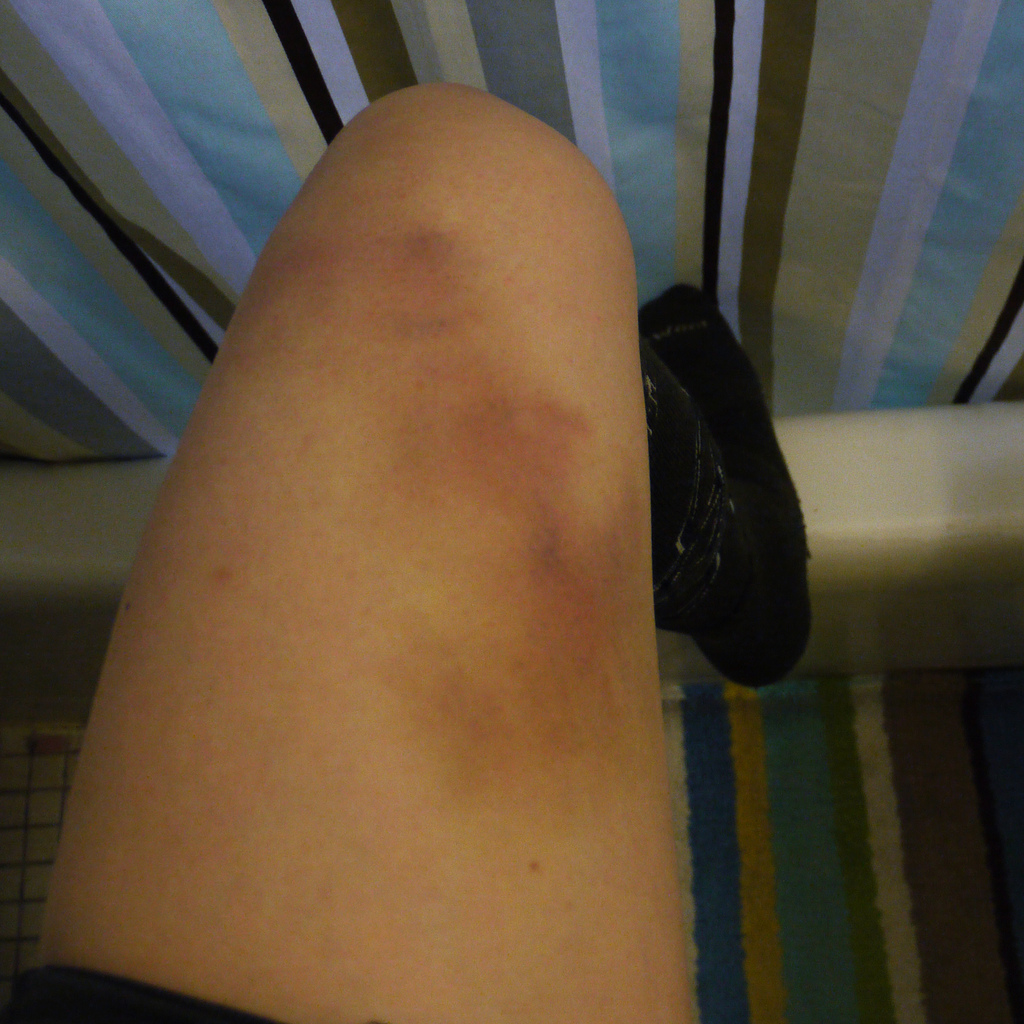 bruise