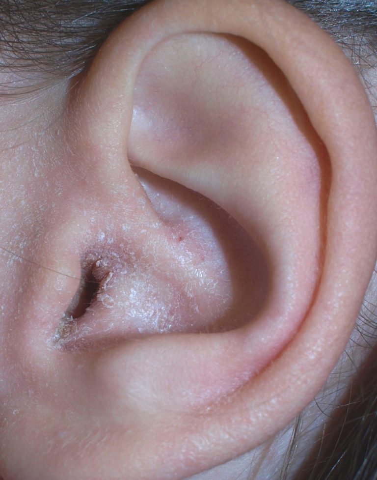 7 Signs Of Health Issues Your Earwax Could Reveal