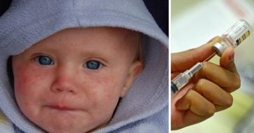 measles-outbreak