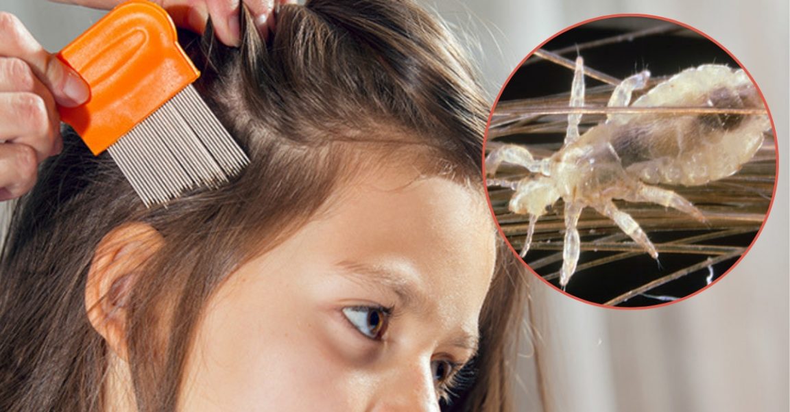 Mom's Home Remedy For Head Lice — Have You Tried It?