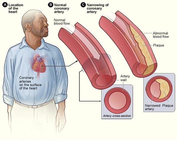 heart disease 