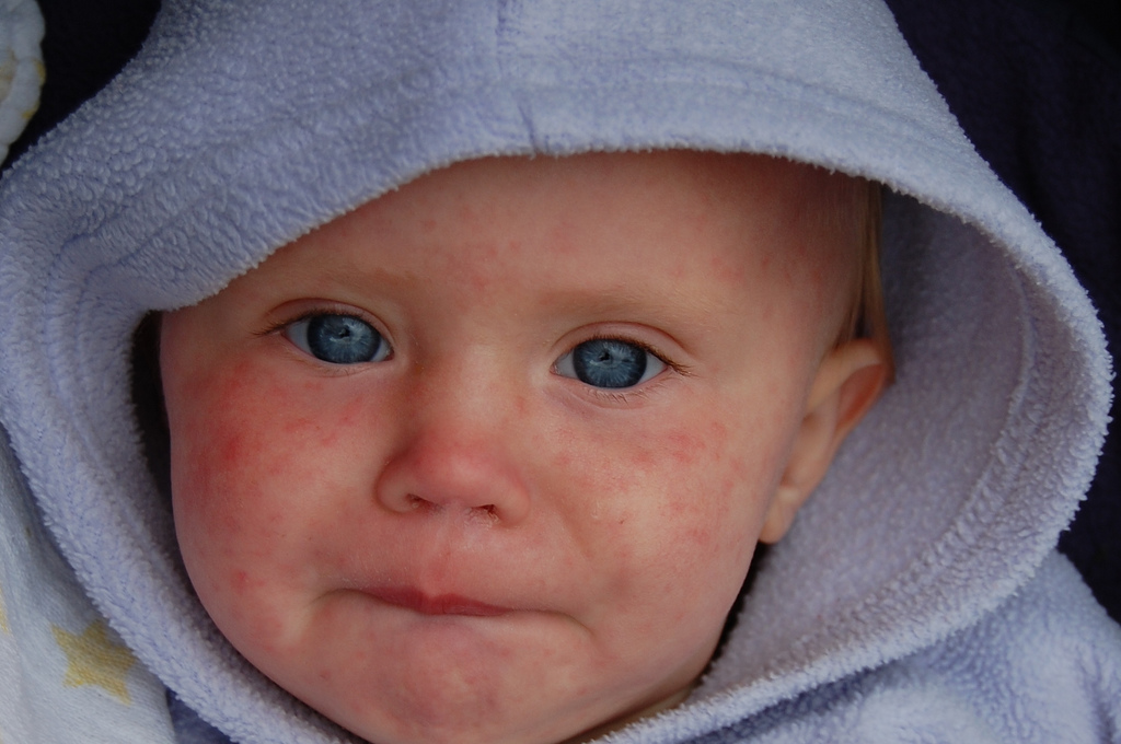 kid with measles 