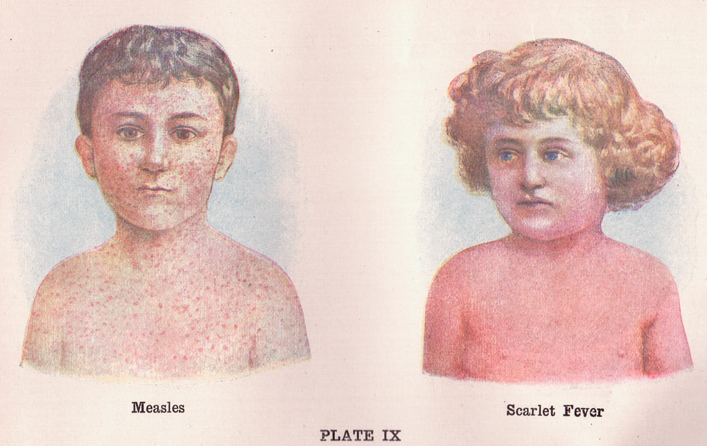 measles 