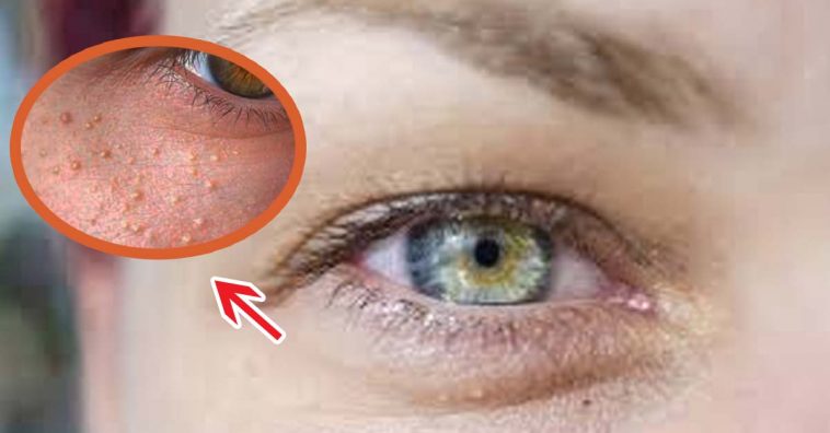 the-best-natural-ways-to-treat-milia-around-your-eyes