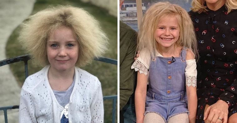 Uncombable Hair Syndrome Is A Real Genetic Condition uncombable-hair-syndrome-is-a-real-genetic-condition
