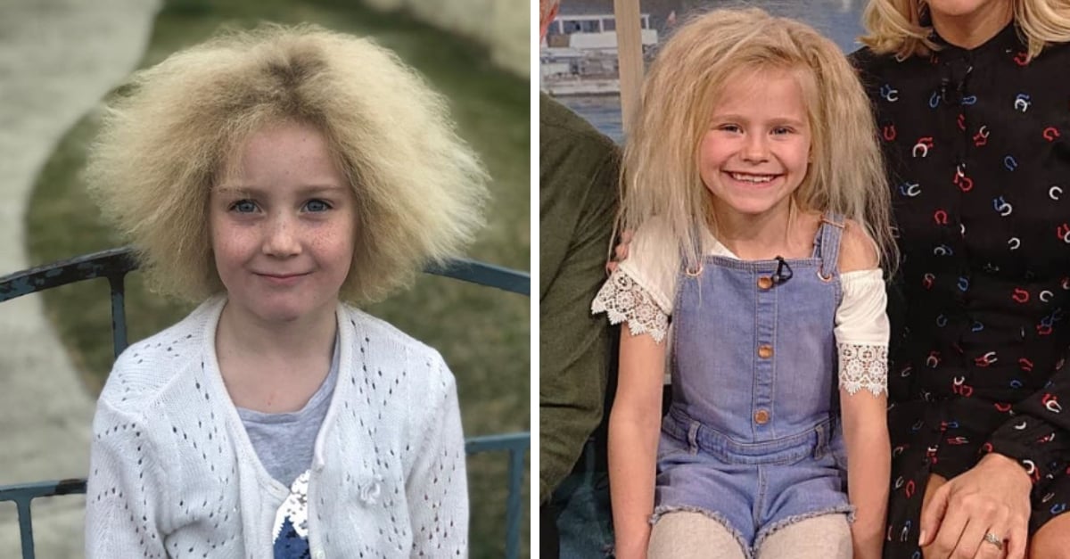 Uncombable Hair Syndrome Is A Real Genetic Condition