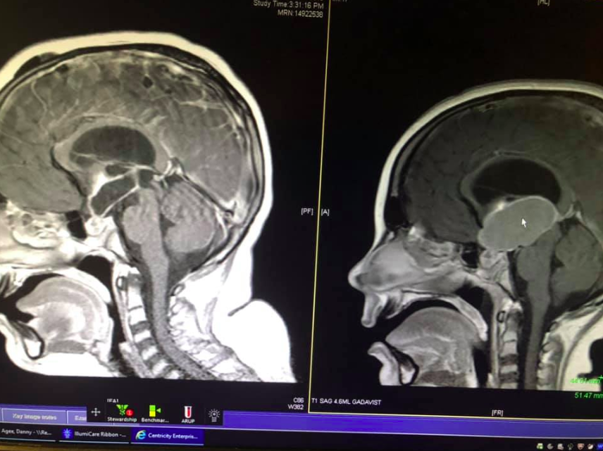 Brian scans of Danny Agee before and after surgery
