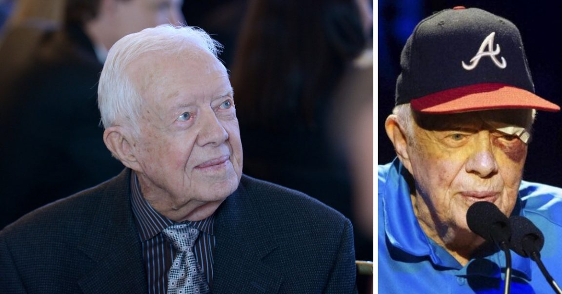 Jimmy Carter Has Black Eye And Stitches After Fall