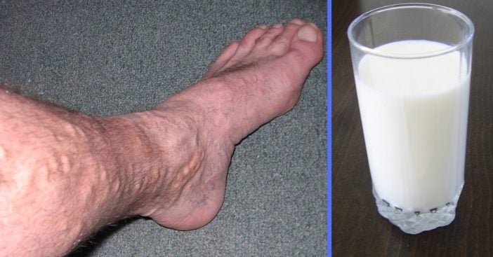 Learn the simple recipe to cure varicose veins at home
