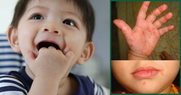 How To Prevent Your Little Ones From Catching & Spreading Hand, Foot, & Mouth Disease