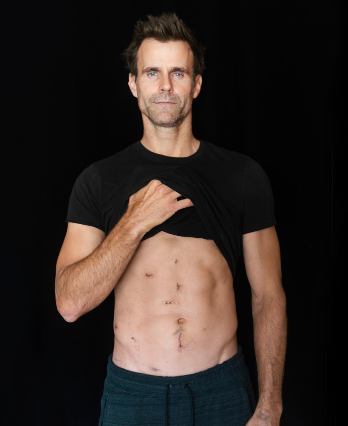 cameron mathison shows off kidney cancer surgery scars