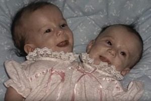 Abby and Brittany Hensel as babies