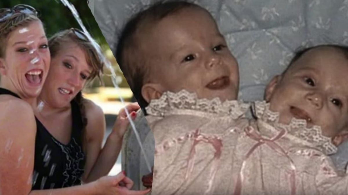 10 interesting facts about conjoined twins brittany and abby hensel both br...