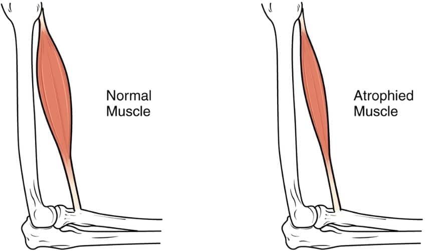 muscle atrophy 