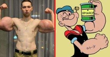 real-life popeye gets 3 lbs of dead muscle removed from biceps