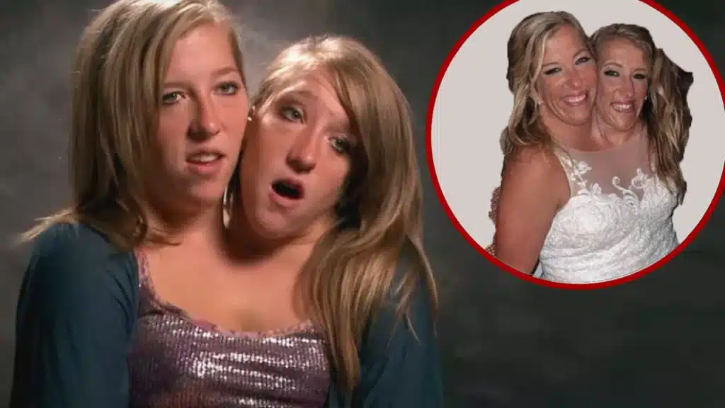 Conjoined Twins Brittany And Abby Hensel Are Married?