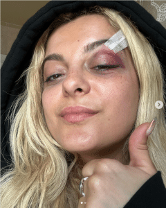 Bebe Rexha after she was struck by a cell phone